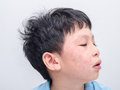 二次法病例1
